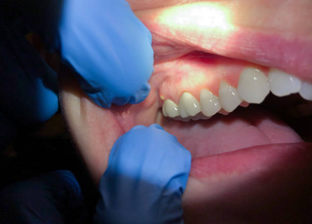 Best Emergency Tooth Extraction in Wolfhurst, OH